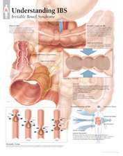 Understanding Ibs Chart: Laminated Wall Chart