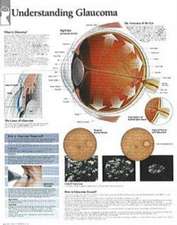 Understanding Glaucoma Chart: Wall Chart