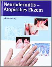 Neurodermitis - Atopisches Ekzem