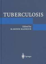 Tuberculosis