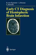 Early CT Diagnosis of Hemispheric Brain Infarction