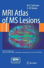 MRI Atlas of MS Lesions